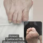 Обробка врослого нігтя